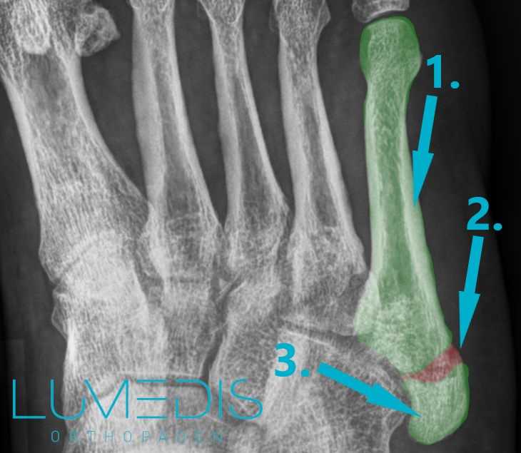 Behandlung und Genesungszeit eines Mittelfußknochenbruchs