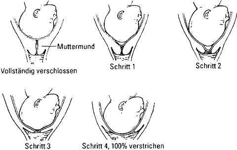 Tipps und Tricks, um die Geburt zu beschleunigen