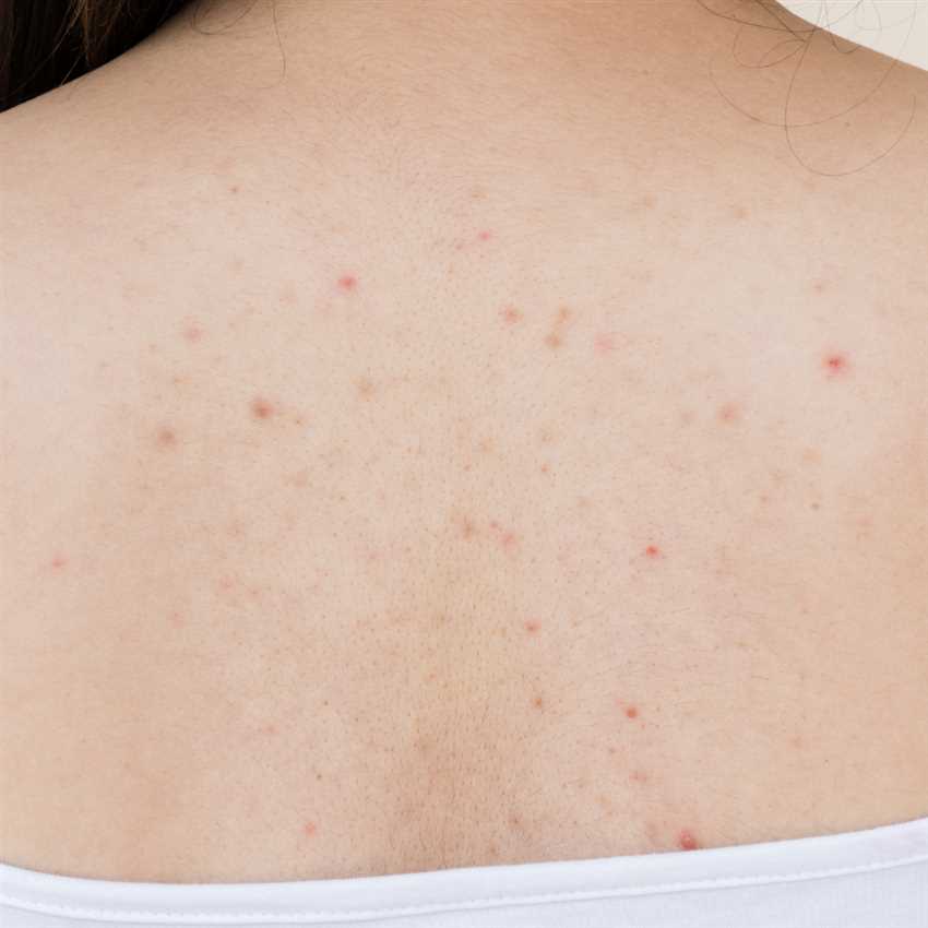 Wie wirkt Salicylsäure gegen Akne auf dem Rücken?