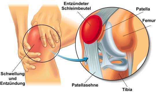 Ursachen einer Schleimbeutelentzündung im Knie