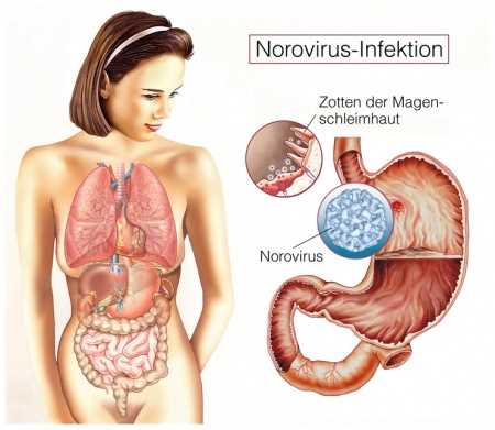 Was ist der Norovirus?