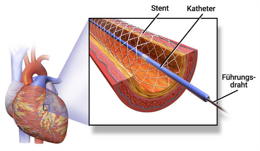 Was sind Stents?