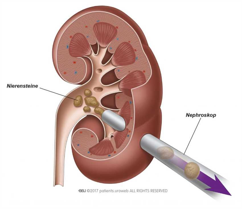 Schweregrad der Nierensteine