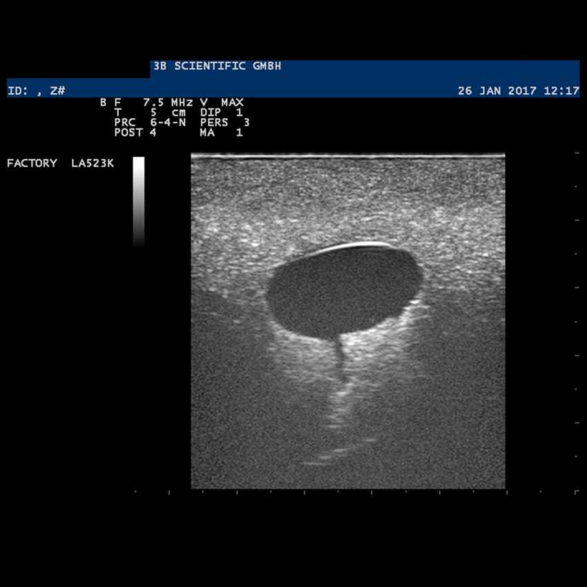 Wie sieht eine Zyste auf einem Ultraschallbild aus?