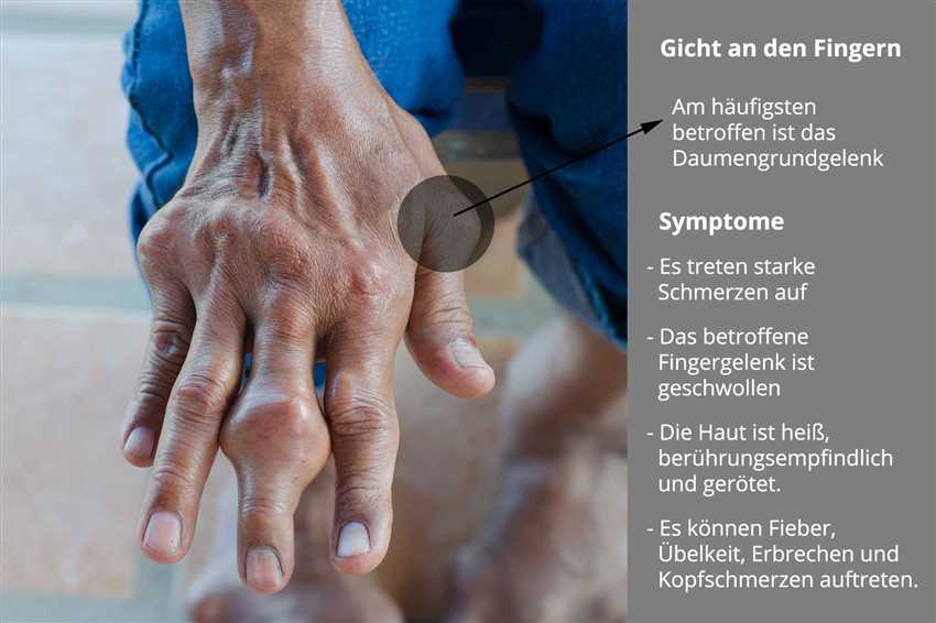 Diagnose und Behandlung von Gicht in den Händen