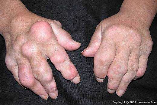 Symptome von Gicht in den Händen