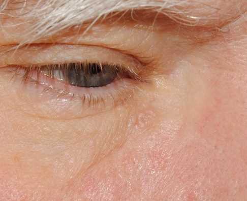 Weißer Hautkrebs: Erkennungsmerkmale auf der Nase