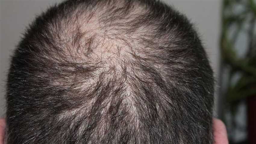 Faktoren, die die Menge an Haarausfall beeinflussen